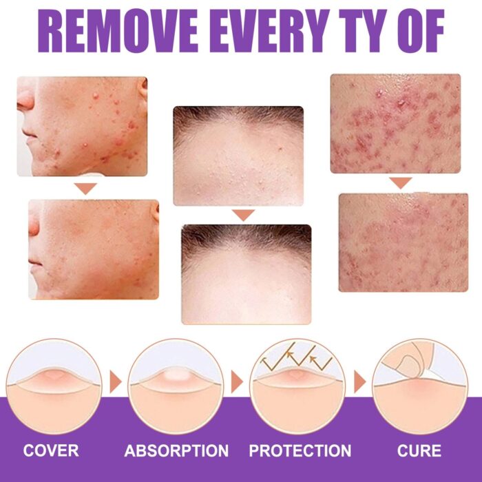 Skin Tag Remover Wart Remover Skin Tag Removal Quickly and Easily Remove - Image 3